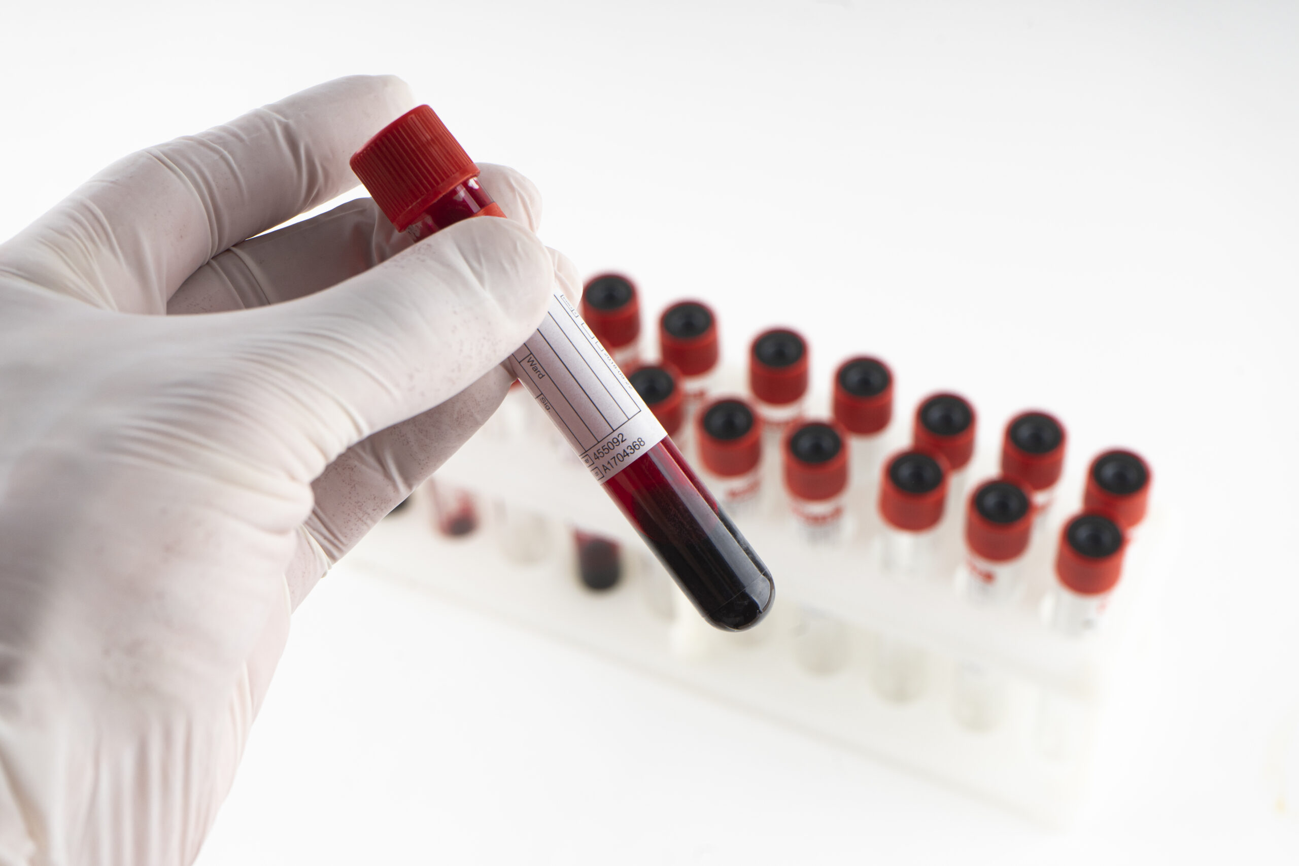 Deficiência de vitamina B12: sintomas e tratamentos