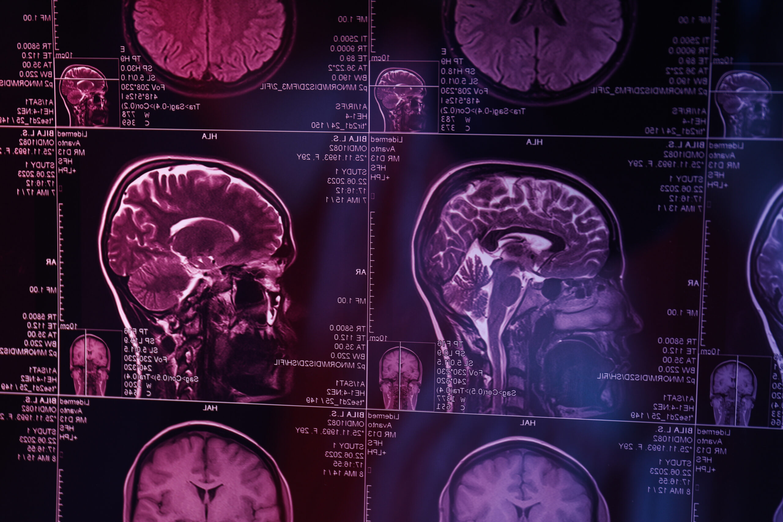 O que é neuroinflamação?